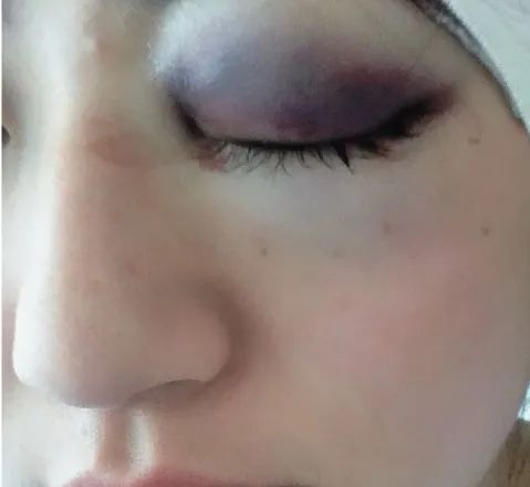 日本大专女孩打工途中左眼失明!恢复后出道当歌手,却被指责装可怜? 日本大专女孩打工途中左眼失明!恢复后出道当歌手,却被指责装可怜?