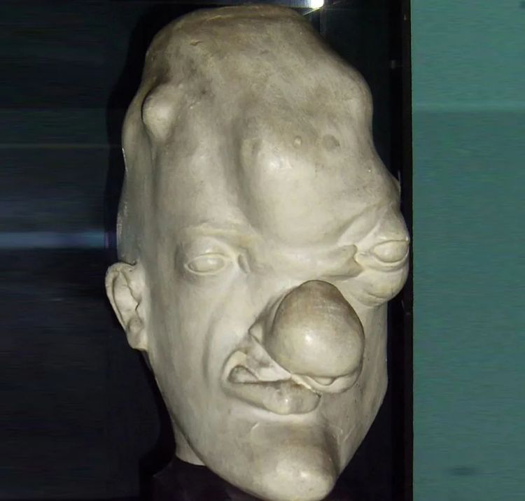 日本飙升的梅毒,到底是什么毒? 日本飙升的梅毒,到底是什么毒?