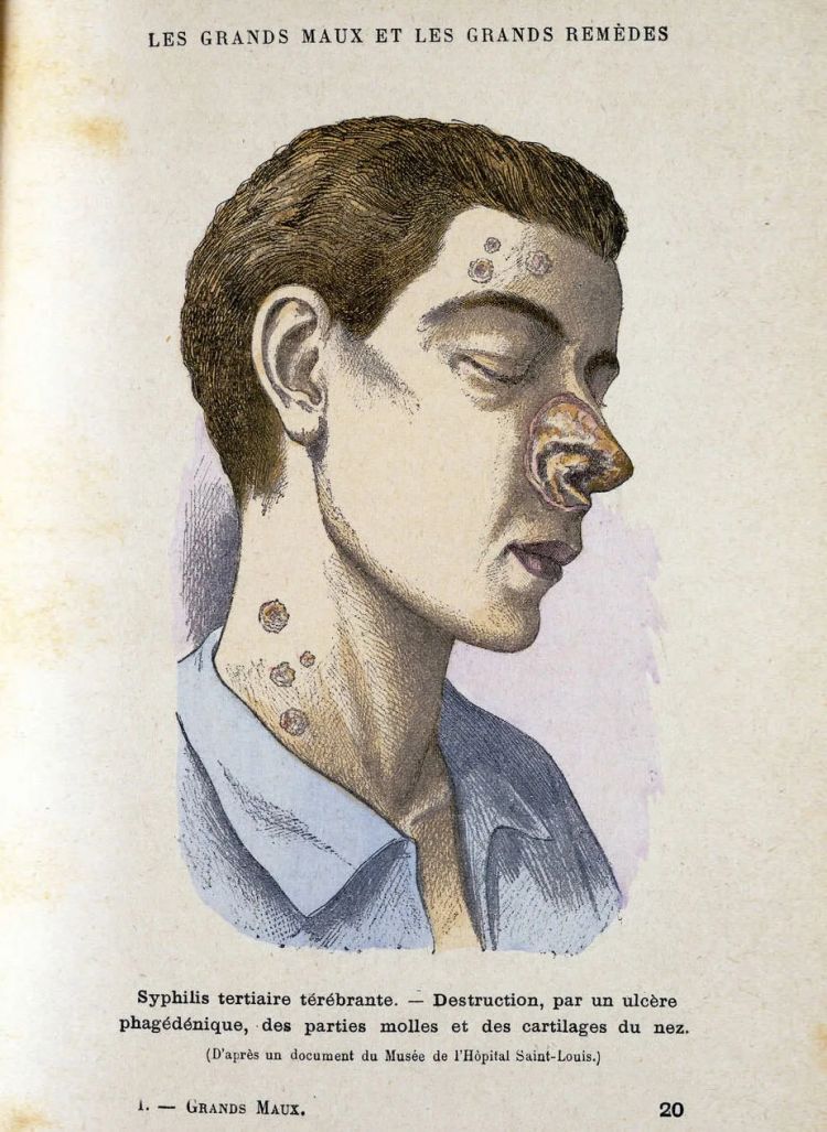 日本飙升的梅毒,到底是什么毒? 日本飙升的梅毒,到底是什么毒?