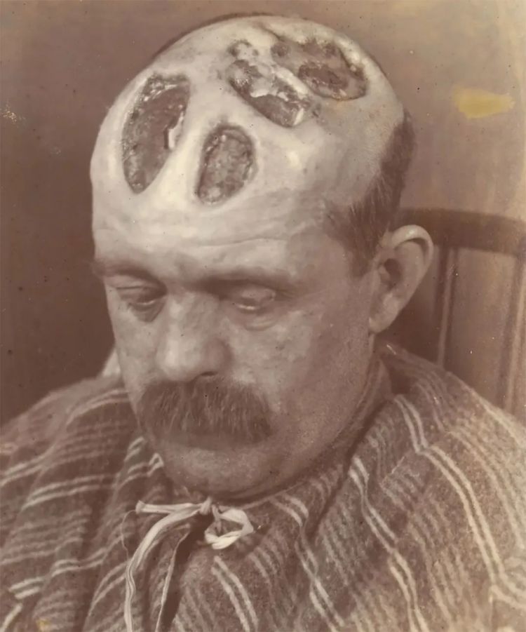 日本飙升的梅毒,到底是什么毒? 日本飙升的梅毒,到底是什么毒?